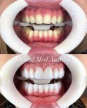 До и после установки виниров Emax в Dental Med Austria & Elixence, результат улыбки