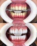 Результат до и после установки виниров Emax в Dental Med Austria & Elixence, преображение улыбки