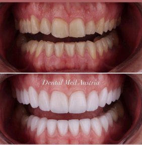 Результаты до и после установки виниров Emax в Dental Med Austria & Elixence, преображение улыбки