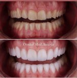 Результаты до и после установки виниров Emax в Dental Med Austria & Elixence, преображение улыбки