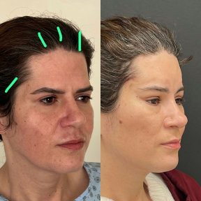 before-after photo lifting-lba
