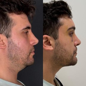 before-after photo lifting-lba