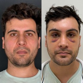 before-after photo lifting-lba