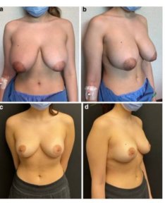 before-after photo inverted-nipple-surgery