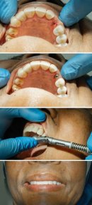 before-after photo implantacia-zuba