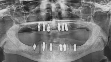 before-after photo implantacia-zuba