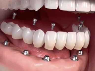 before-after photo implantacia-zuba