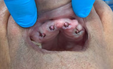 before-after photo implantacia-zuba