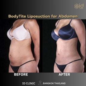 before-after photo 360-liposuction