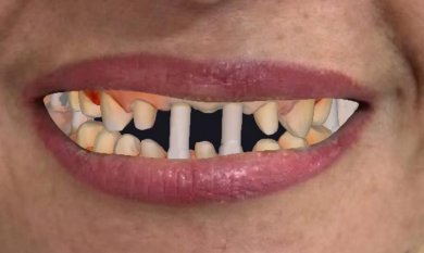 before-after photo implantacia-zuba