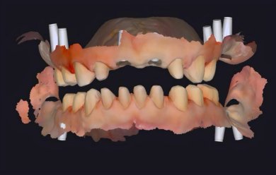 before-after photo implantacia-zuba