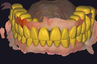 before-after photo implantacia-zuba
