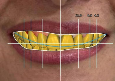 before-after photo implantacia-zuba