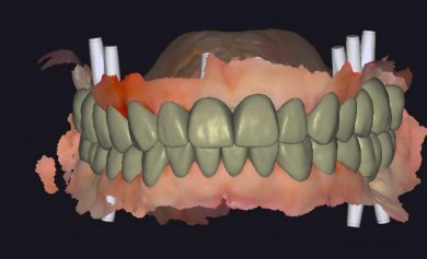 before-after photo implantacia-zuba