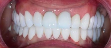 before-after photo implantacia-zuba