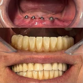 before-after photo implantacia-zuba