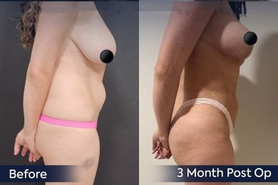 before-after photo brazilian-butt-lift