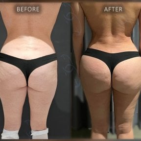 before-after photo brazilian-butt-lift