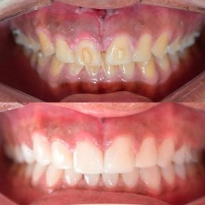 before-after photo dental-bonding