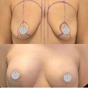 before-after photo breast-augmentation