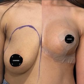 before-after photo breast-augmentation