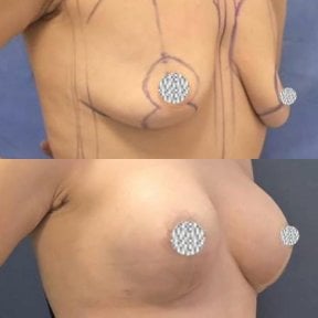 before-after photo breast-augmentation