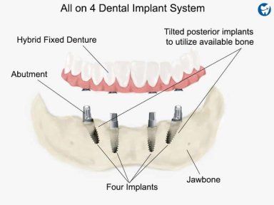 All-on-4 dental implant system diagram showing implant placement and fixed denture result