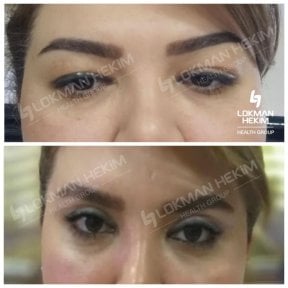 before-after photo plastika-verhnego-i-niznego-veka