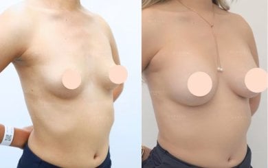 before-after photo rhinoplasty-nose-job