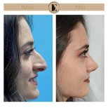 نتائج تجميل الأنف قبل وبعد في عيادة Emre Özenalp، تحسين شكل الأنف الجانبي