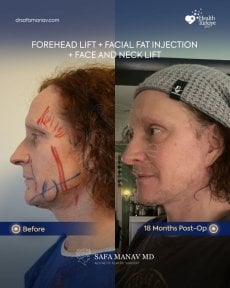 before-after photo facial-fat-transfer