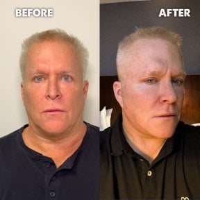 before-after photo facial-fat-transfer