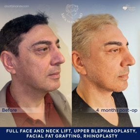 before-after photo facial-fat-transfer