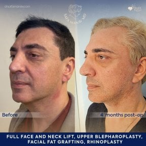 before-after photo facial-fat-transfer