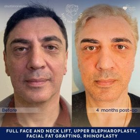 before-after photo facial-fat-transfer