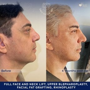 before-after photo facial-fat-transfer