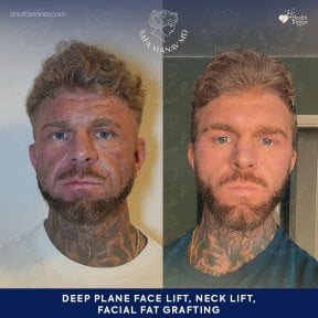 before-after photo facial-fat-transfer
