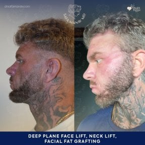 before-after photo facial-fat-transfer