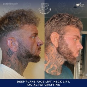 before-after photo facial-fat-transfer