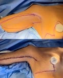 Before and after arm lift (brachioplasty) result at Dr. Michel Salameh - Plastic And Aesthetic Surgery