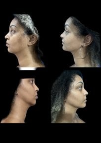 Before and after neck liposuction results at Dr. Michel Salameh - Plastic And Aesthetic Surgery
