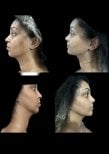Before and after neck liposuction results at Dr. Michel Salameh - Plastic And Aesthetic Surgery