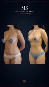 Before and after breast augmentation results at Dr. Michel Salameh - Plastic And Aesthetic Surgery