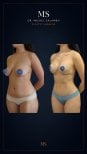 Before and after breast augmentation results at Dr. Michel Salameh - Plastic And Aesthetic Surgery