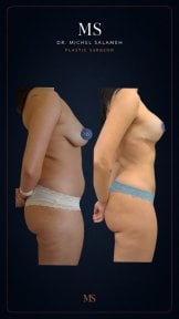 Before and after breast augmentation results at Dr. Michel Salameh - Plastic And Aesthetic Surgery