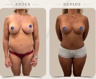 Before and after breast augmentation results at Dr. Michel Salameh - Plastic And Aesthetic Surgery