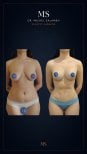 Before and after breast augmentation results at Dr. Michel Salameh - Plastic And Aesthetic Surgery