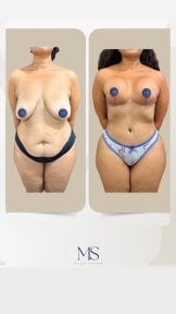 Before and after breast augmentation and body contouring at Dr. Michel Salameh clinic, results