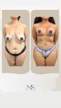 Before and after breast augmentation and body contouring at Dr. Michel Salameh clinic, results