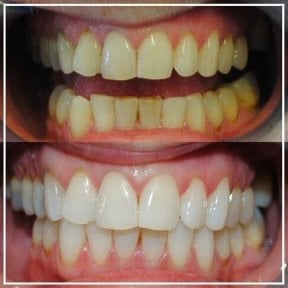 before-after photo tooth-whitening